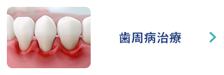 歯周病治療