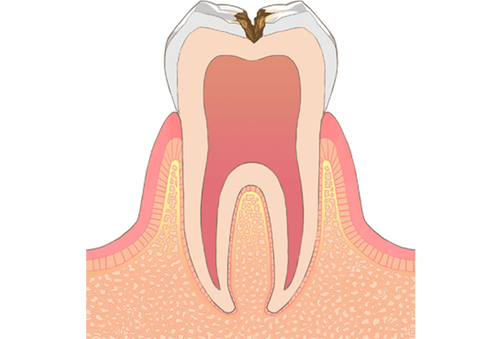 C2【象牙質の虫歯】