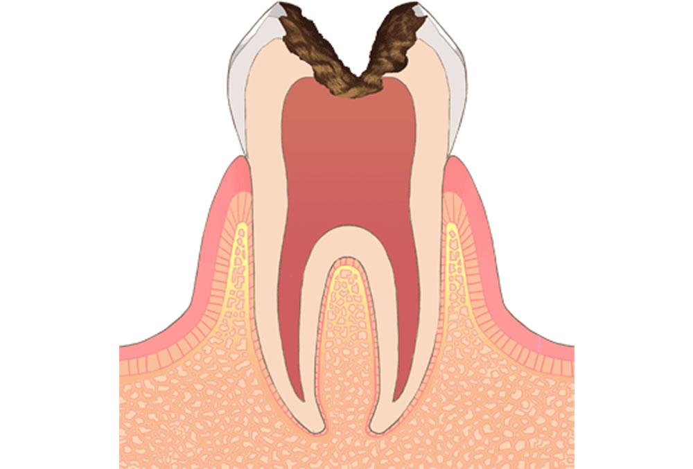 C3【歯の神経にまで進行した虫歯】