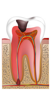 虫歯菌が神経にまで進行した歯