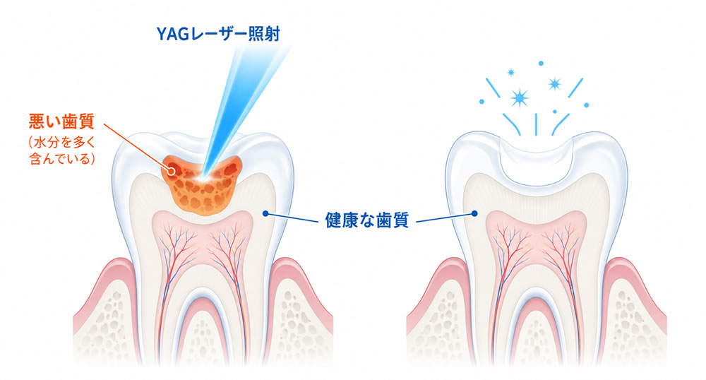 ヤグレーザーを活用した低侵襲な虫歯治療