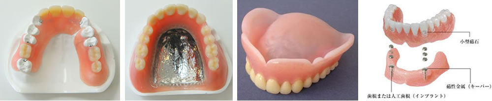 様々な特徴の入れ歯