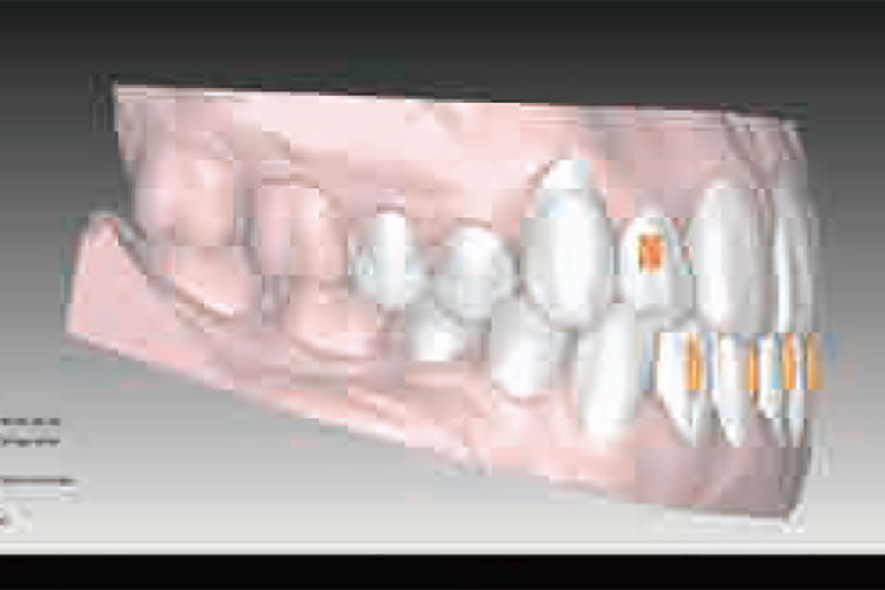 歯の動きを確認できる