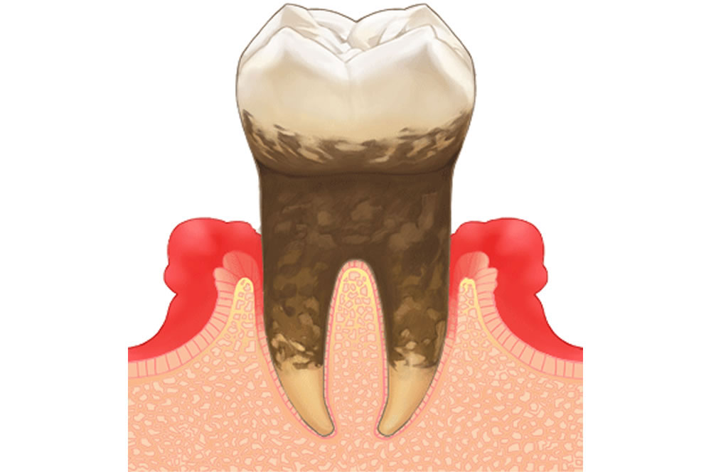 歯周病の原因や症状